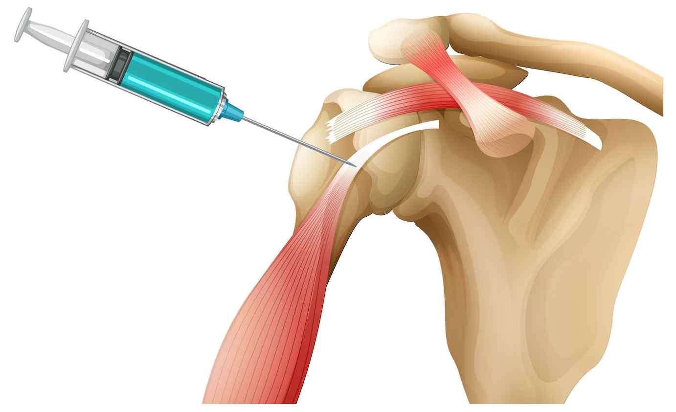 Regenerative medicine for shoulder
